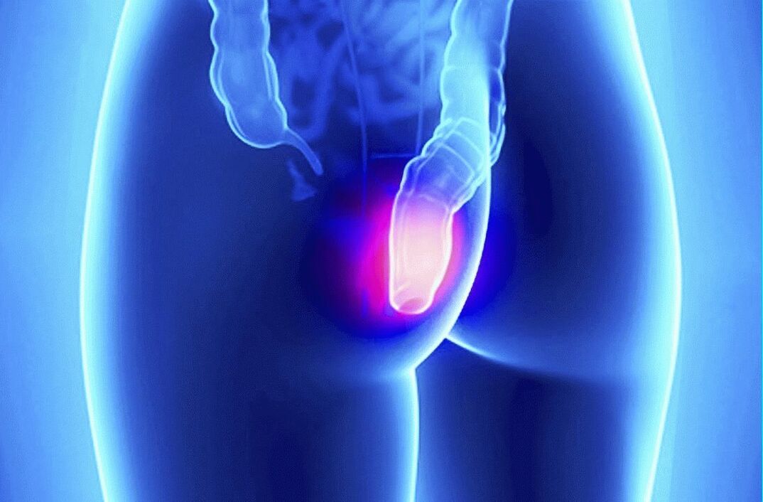 Gelarex można stosować zarówno zewnętrznie, jak i doodbytniczo